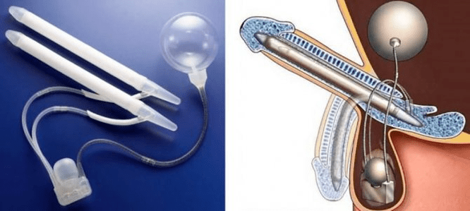 phaloprostheses for penis enlargement