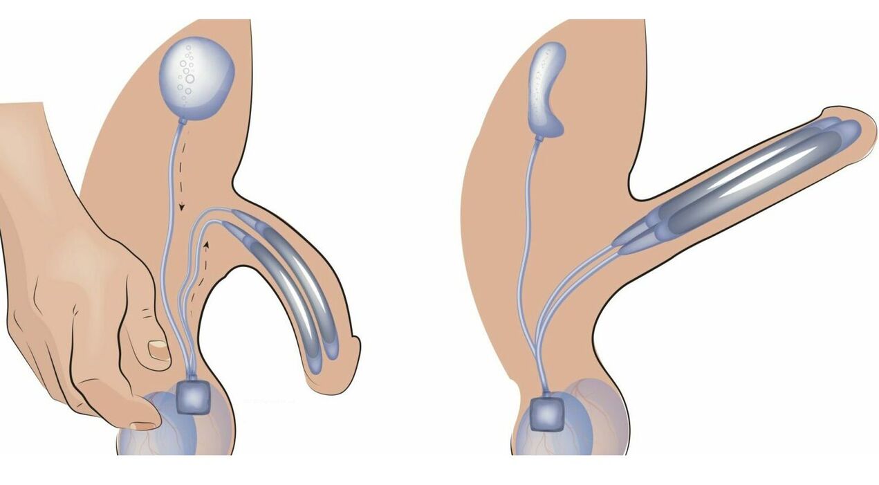 penile prosthesis to enlarge the penis